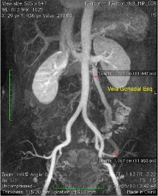 Dilatação da veia gonadal esquerda - varizes pélvicas