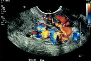 ultrassom-doppler-transvaginal - varizes pélvicas