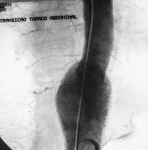 Aneurisma tóraco-abdominal - Angiogrfia - Fluxo Clínica de Cirurgia Vascular