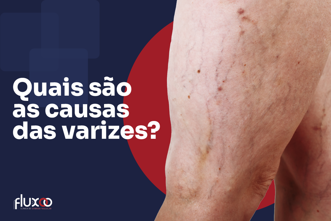 Quais são as causas das varizes nas pernas Cirurgia Vascular