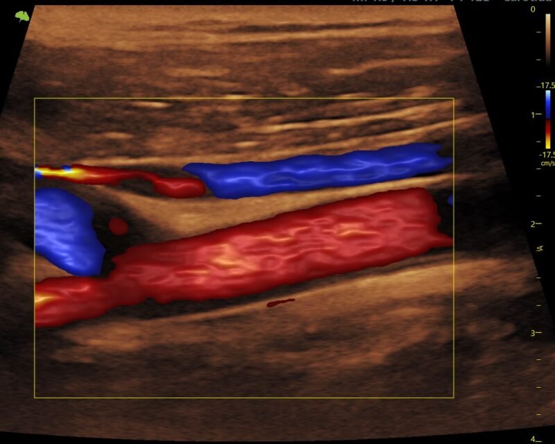 Doppler de artérias carótidas e vertebrais - Fluxo Clínica de Cirurgia Vascular