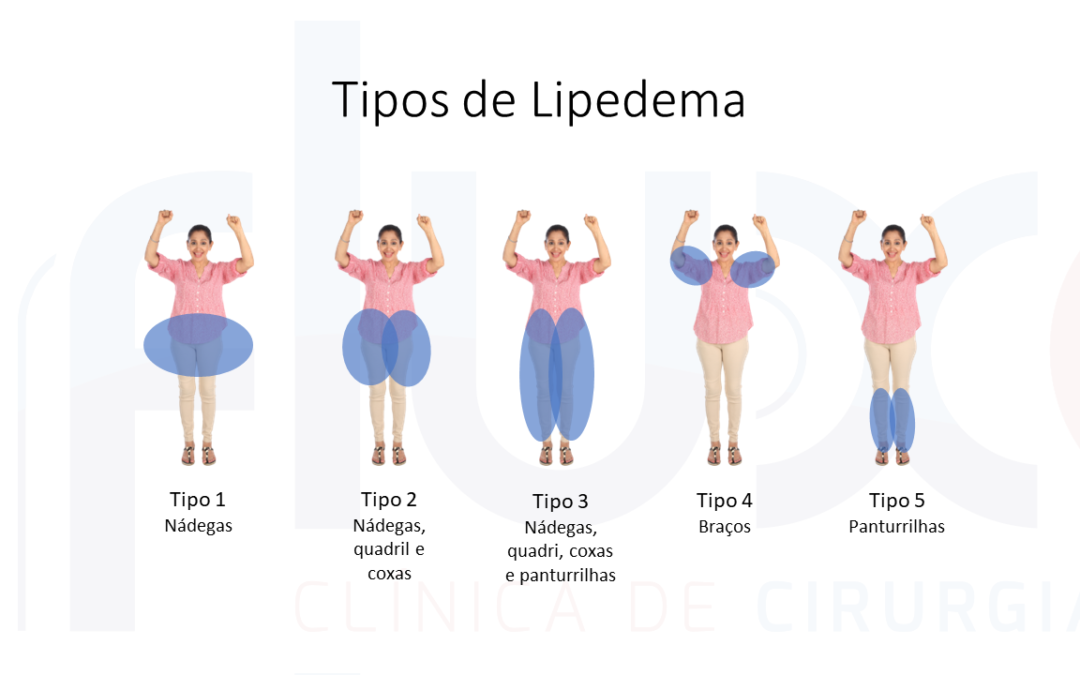 Linfedema | Fluxo - Clínica De Cirurgia Vascular