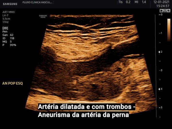 Aneurisma de artéria poplítea - Clínica Fluxo de Cirurgia Vascular